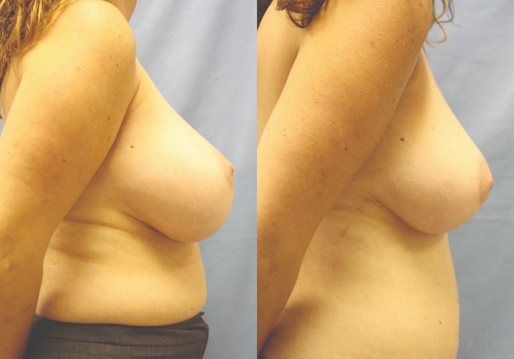 Breast Reduction - Thumbnail 3