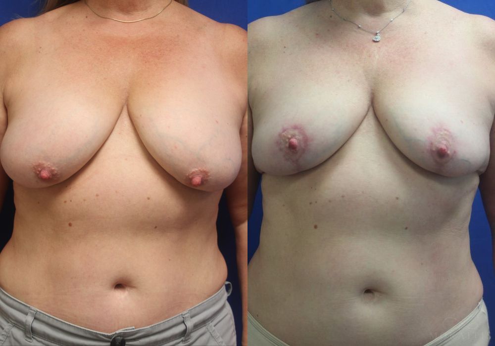 Breast Reduction - Case 15461