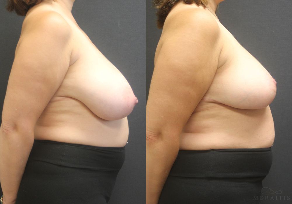 Breast Reduction - Thumbnail 3
