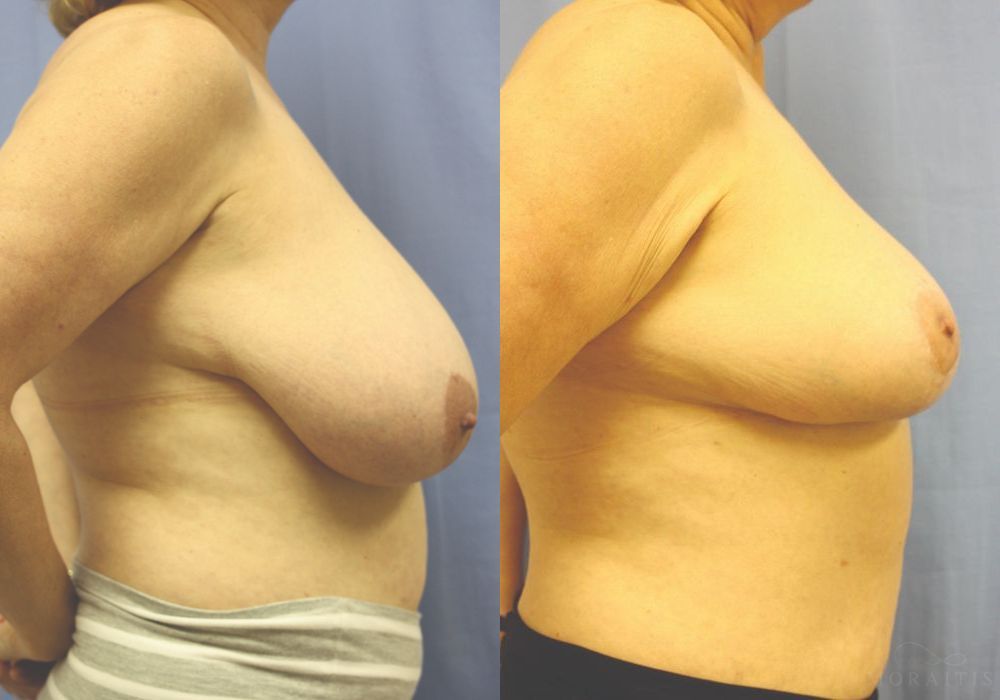 Breast Reduction - Thumbnail 3