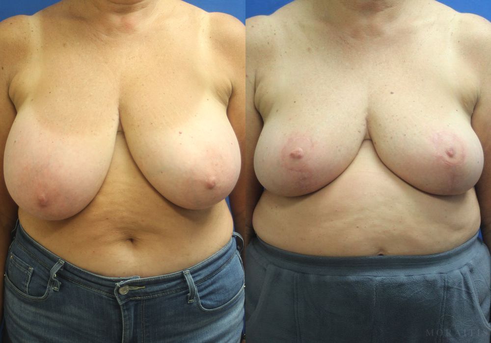 Breast Reduction - Case 15457