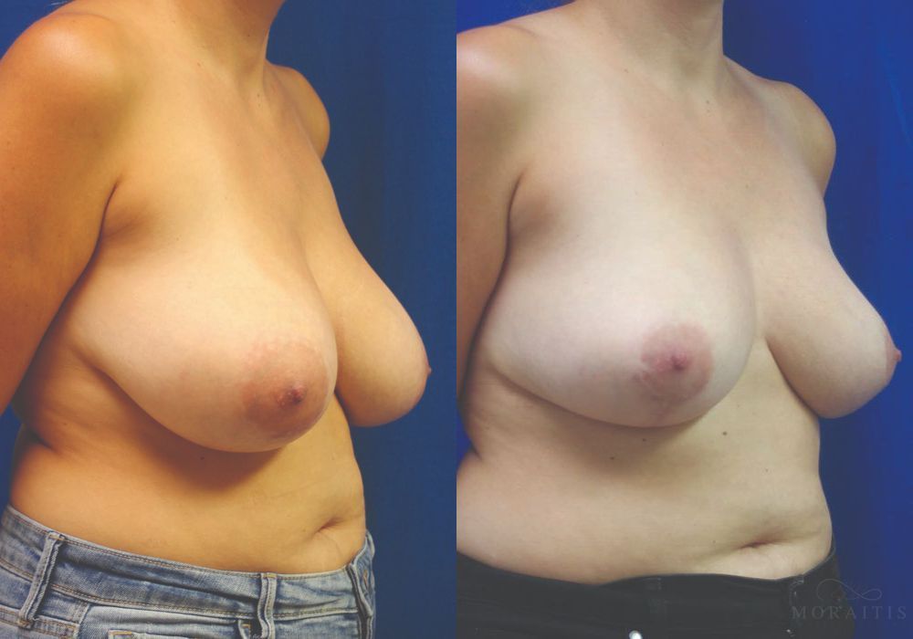 Breast Reduction - Thumbnail 2