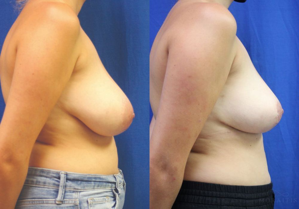 Breast Reduction - Thumbnail 3