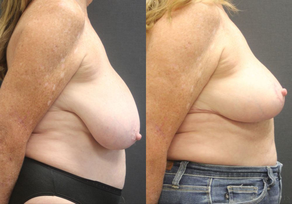Breast Reduction - Thumbnail 3