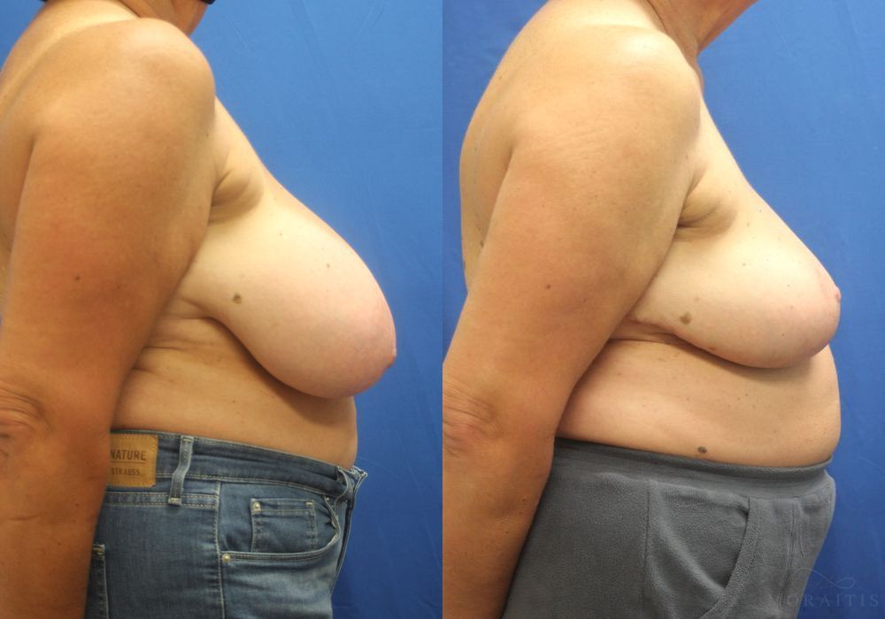 Breast Reduction - Thumbnail 3