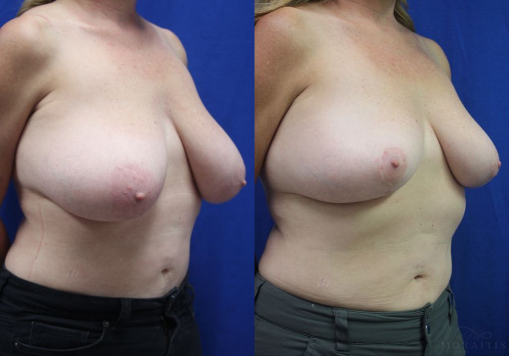 Breast Reduction - Thumbnail 2