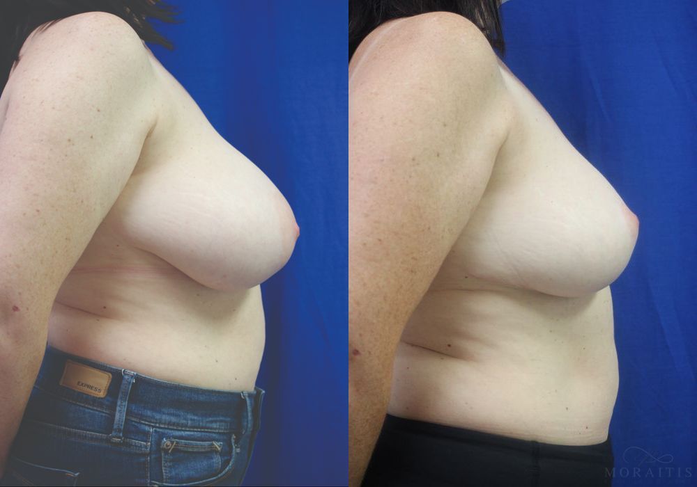 Breast Reduction - Thumbnail 3