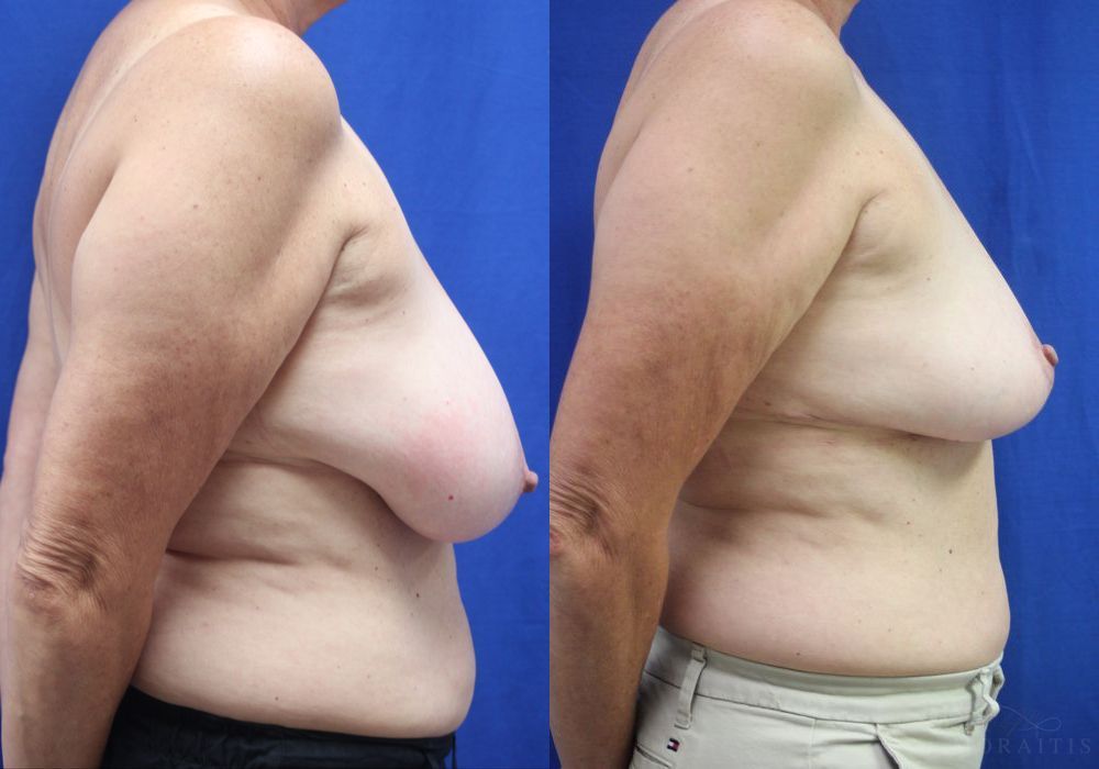 Breast Reduction - Thumbnail 3