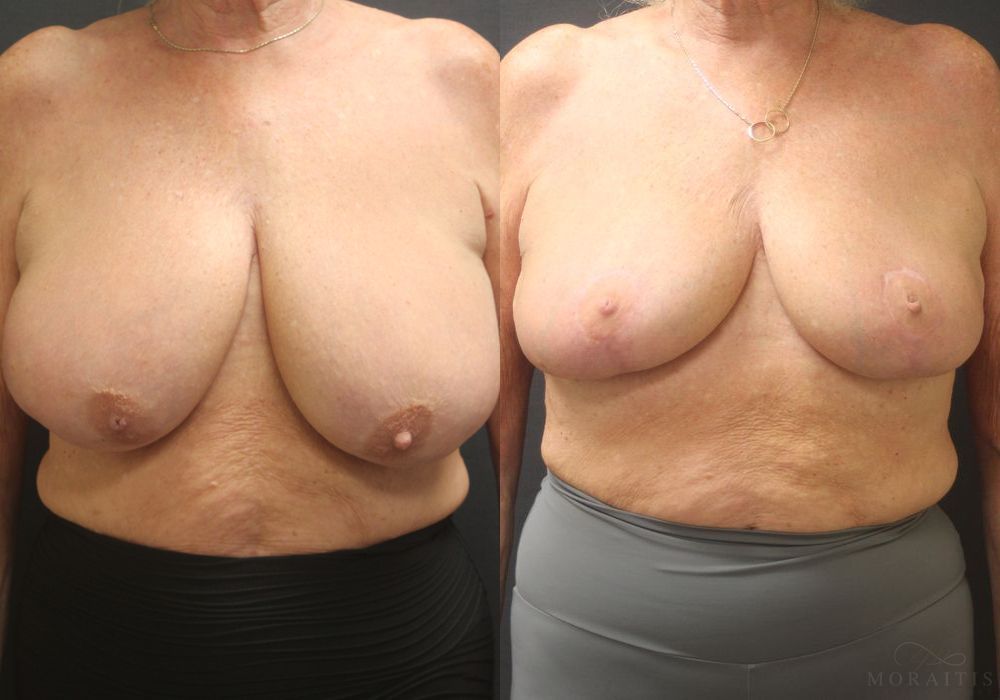 Breast Reduction - Case 15528