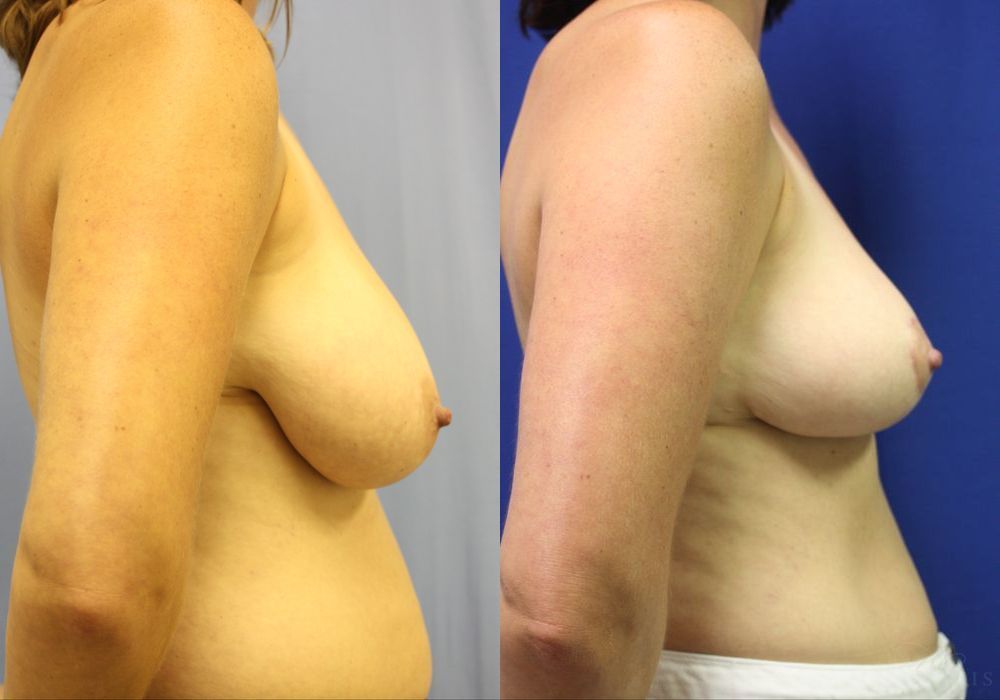Breast Reduction - Thumbnail 3