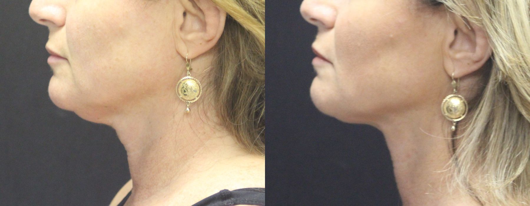 Coolsculpting (non-Surgical Body Contouring) - Case 15307