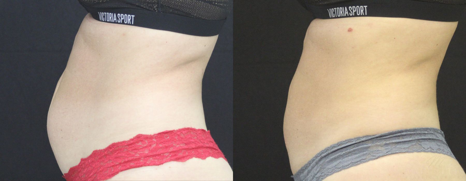 Coolsculpting (non-Surgical Body Contouring) - Thumbnail 3