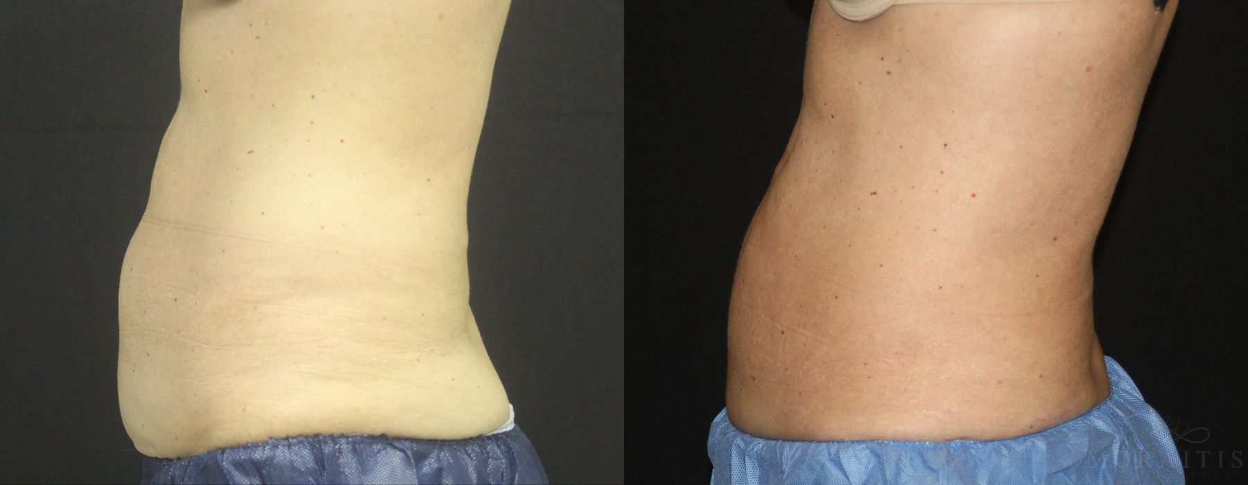 Coolsculpting (non-Surgical Body Contouring) - Thumbnail 3