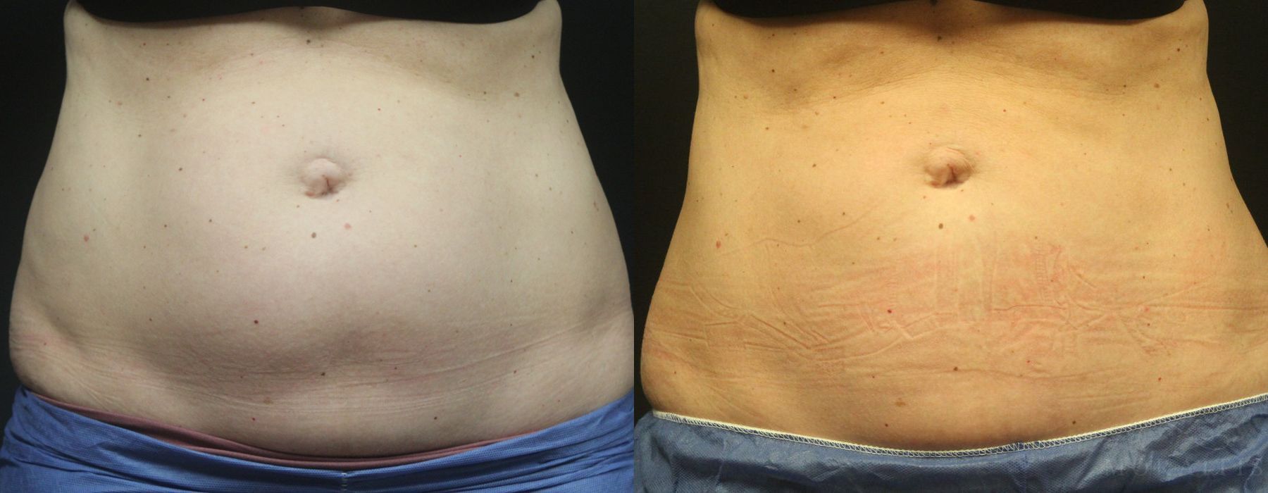 Coolsculpting (non-Surgical Body Contouring) - Case 15322