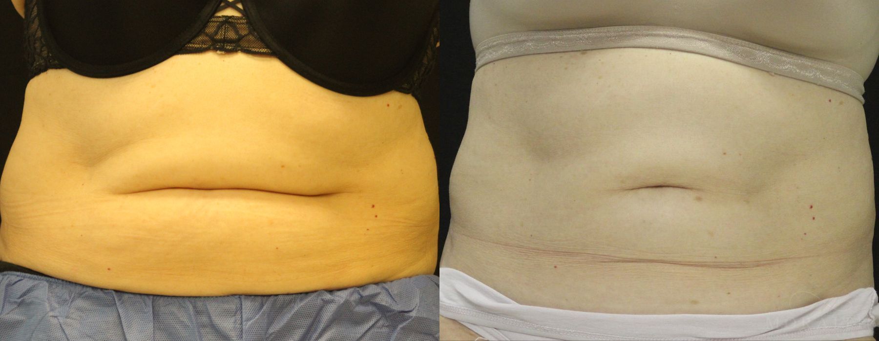 Coolsculpting (Non-Surgical Body Contouring) - Case 19932