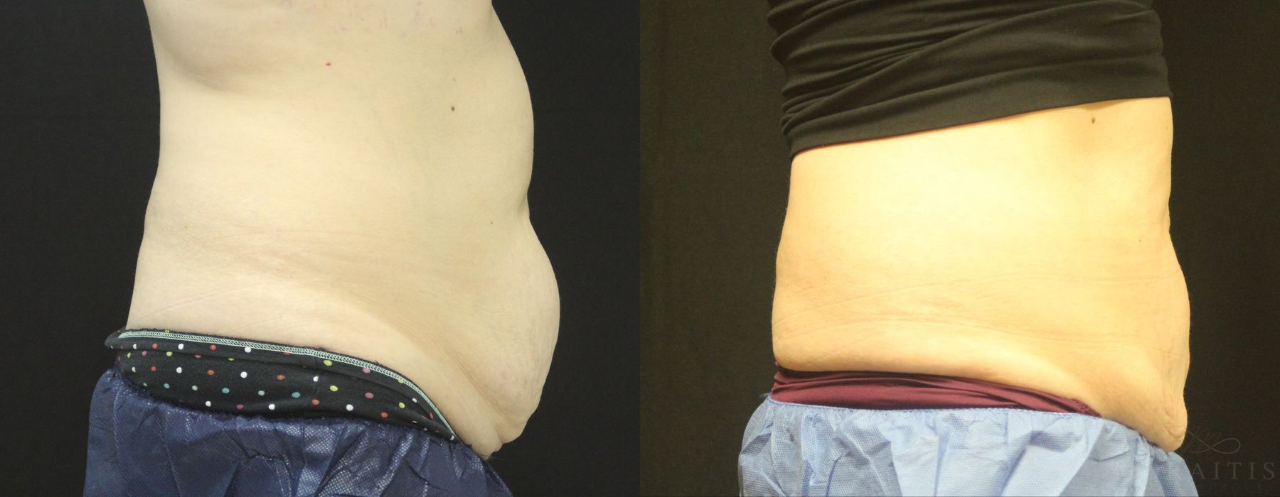Coolsculpting (non-Surgical Body Contouring) - Case 15312