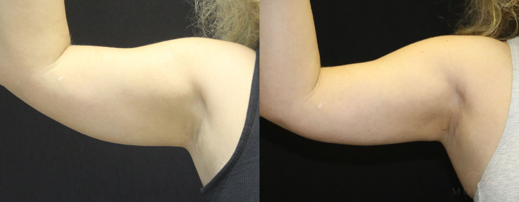 Coolsculpting (Non-Surgical Body Contouring) - Case 19938