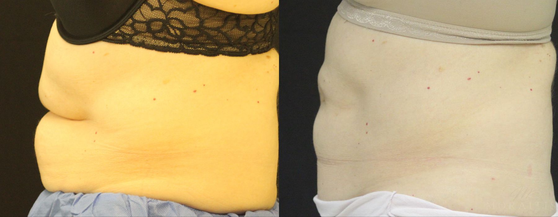 Coolsculpting (Non-Surgical Body Contouring) - Thumbnail 2