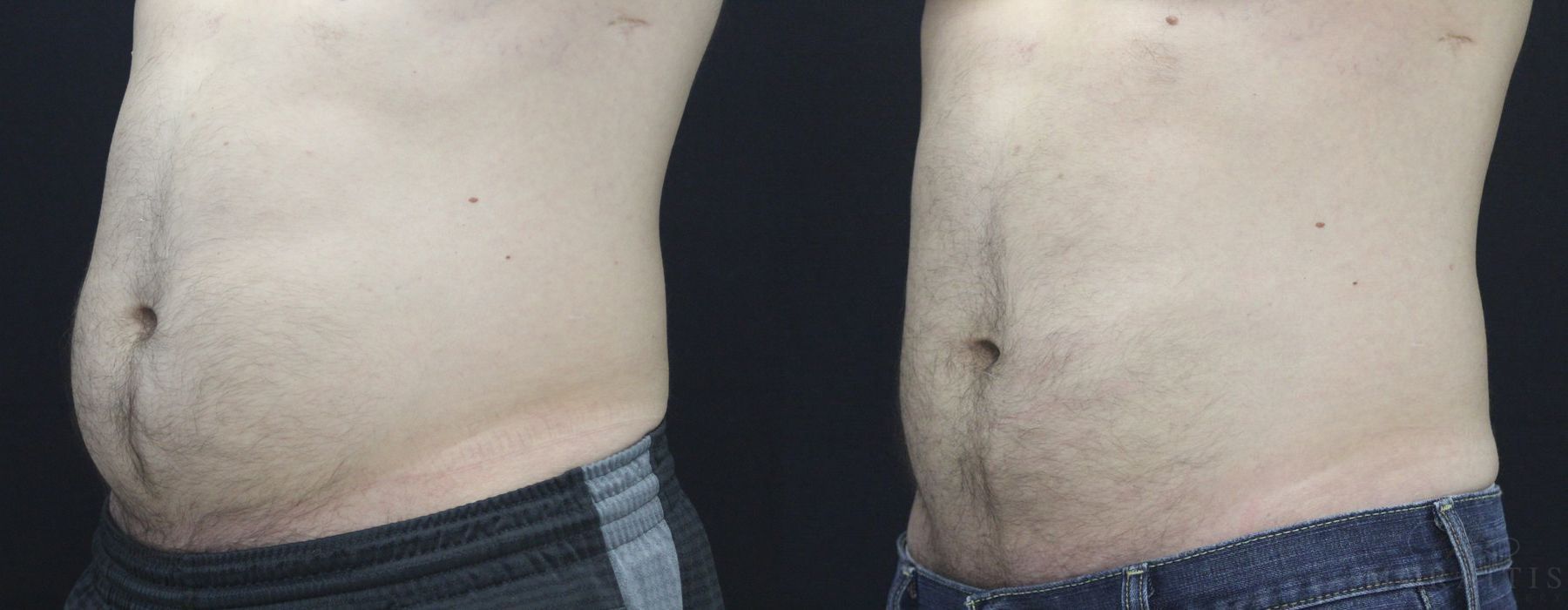 Coolsculpting (non-Surgical Body Contouring) - Case 15308