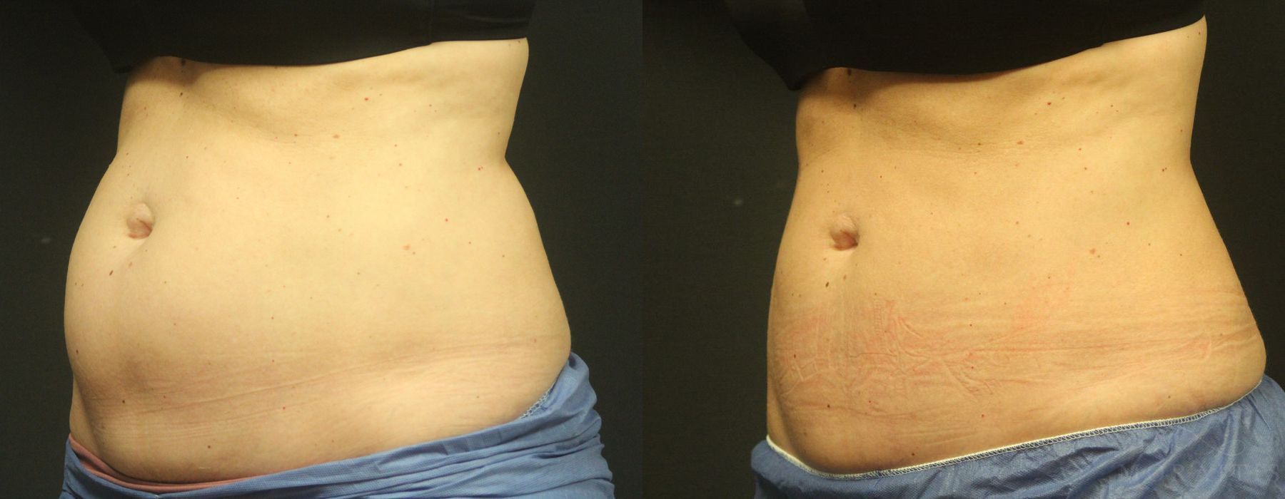 Coolsculpting (non-Surgical Body Contouring) - Thumbnail 2