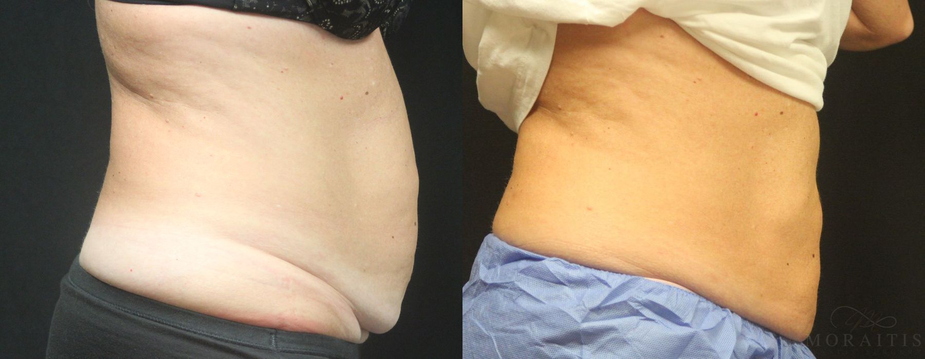 Coolsculpting (non-Surgical Body Contouring) - Thumbnail 2