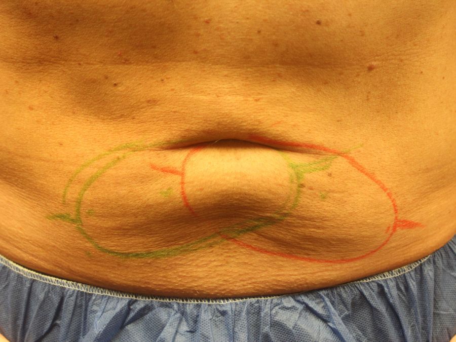 Coolsculpting (non-Surgical Body Contouring) - Thumbnail 3