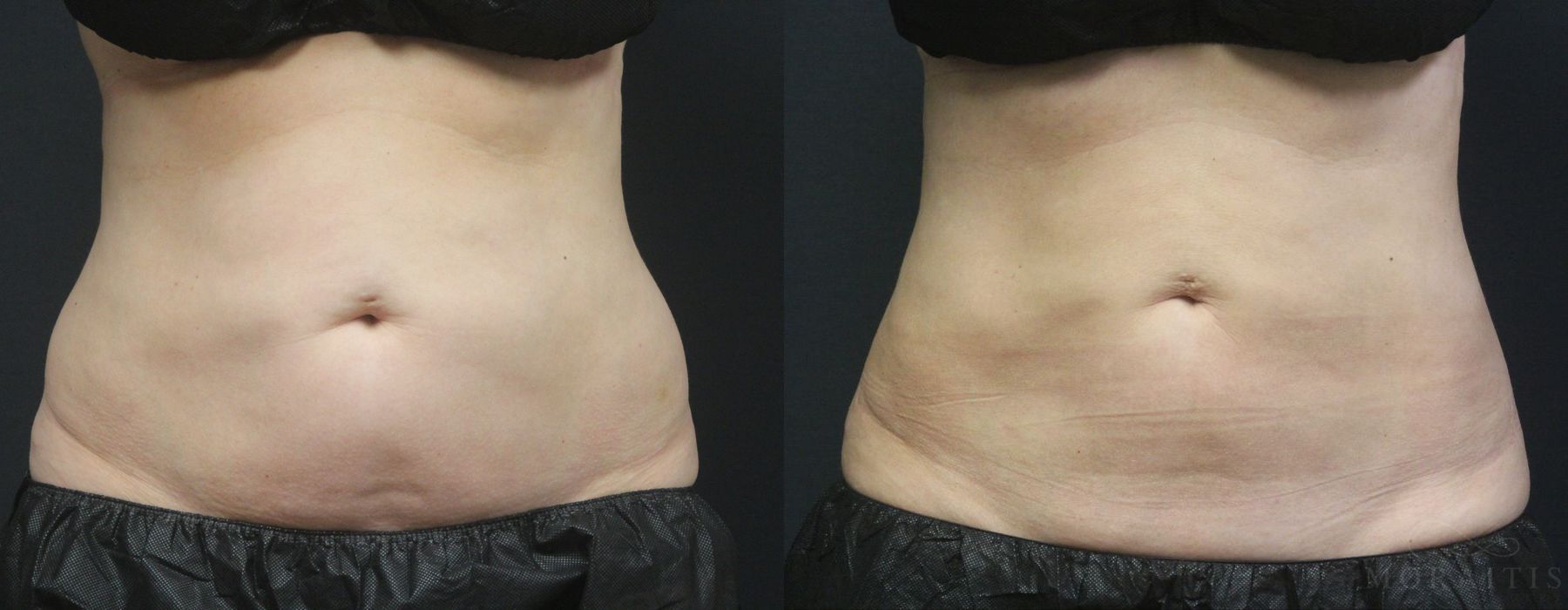 Coolsculpting (non-Surgical Body Contouring) - Case 15300