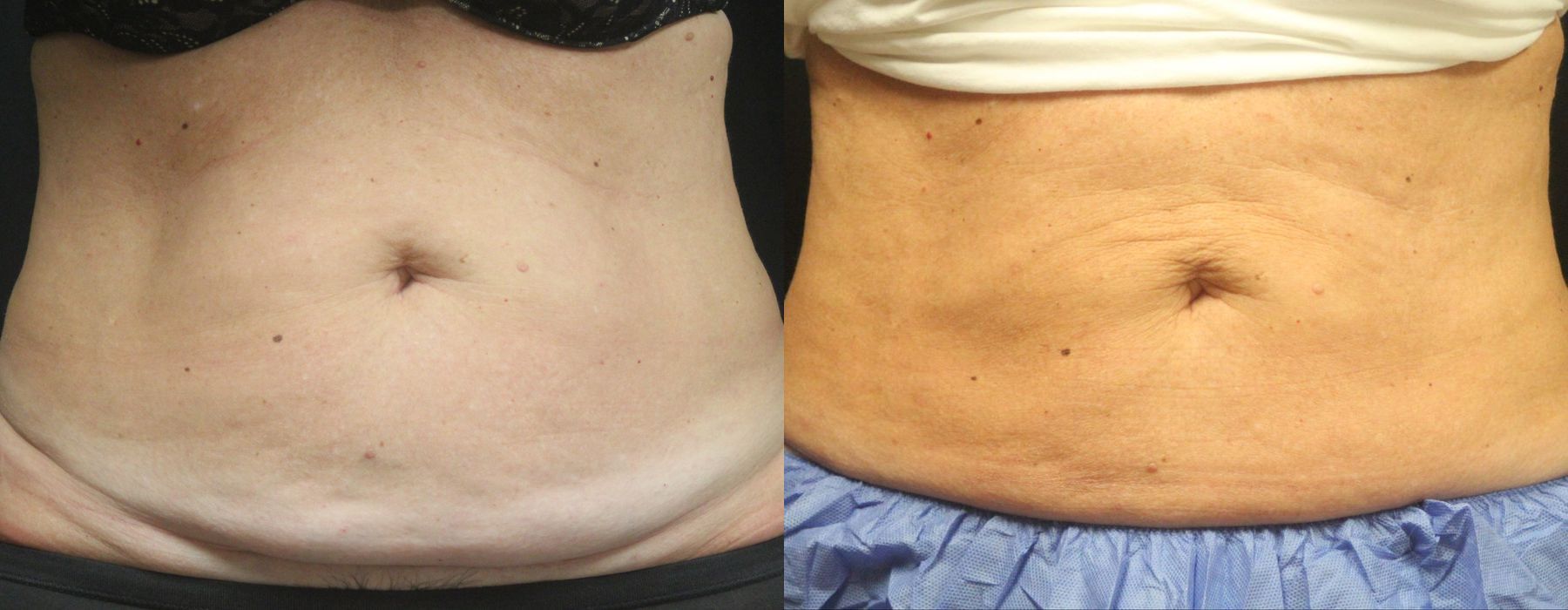 Coolsculpting (non-Surgical Body Contouring) - Case 15304