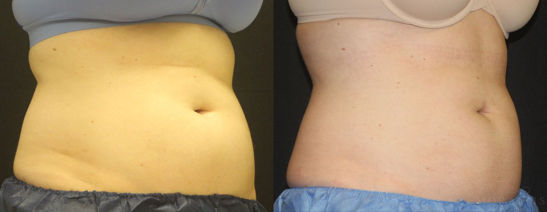 Coolsculpting (non-Surgical Body Contouring) - Thumbnail 2
