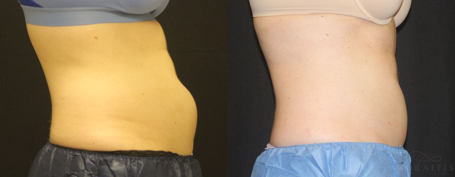 Coolsculpting (non-Surgical Body Contouring) - Case 15326