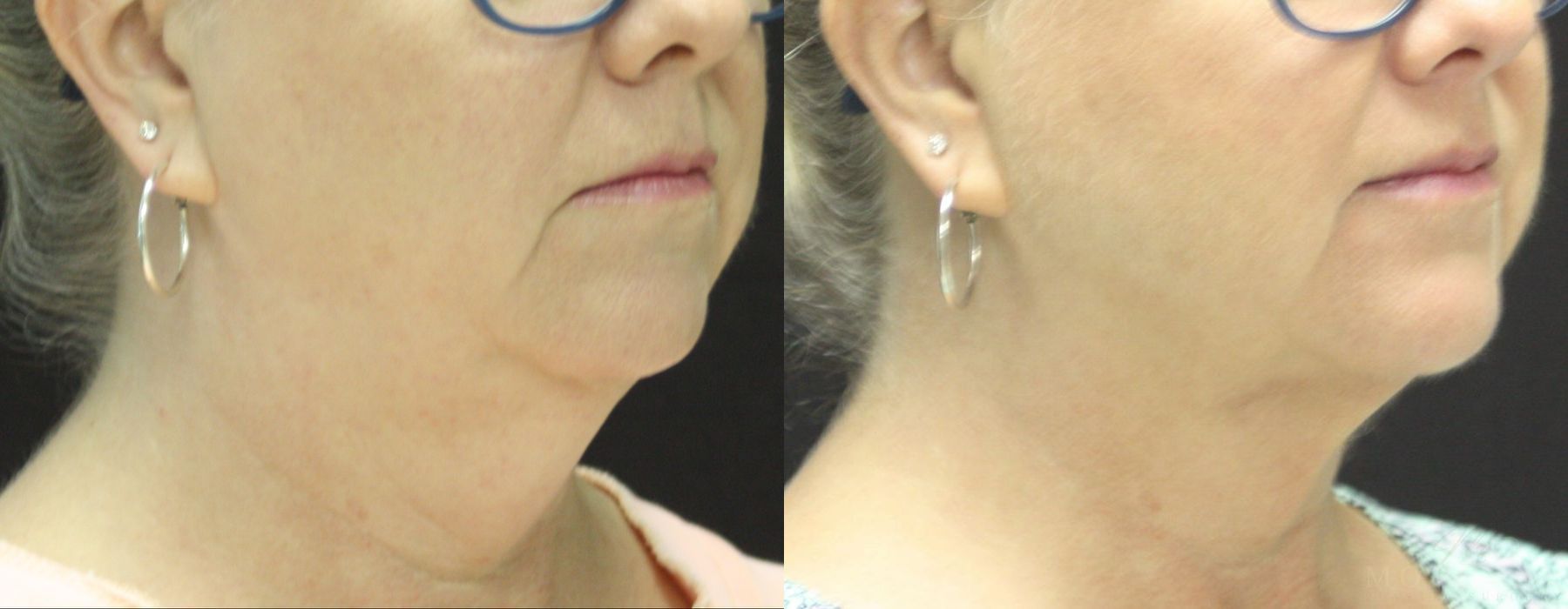 Coolsculpting (non-Surgical Body Contouring) - Thumbnail 2