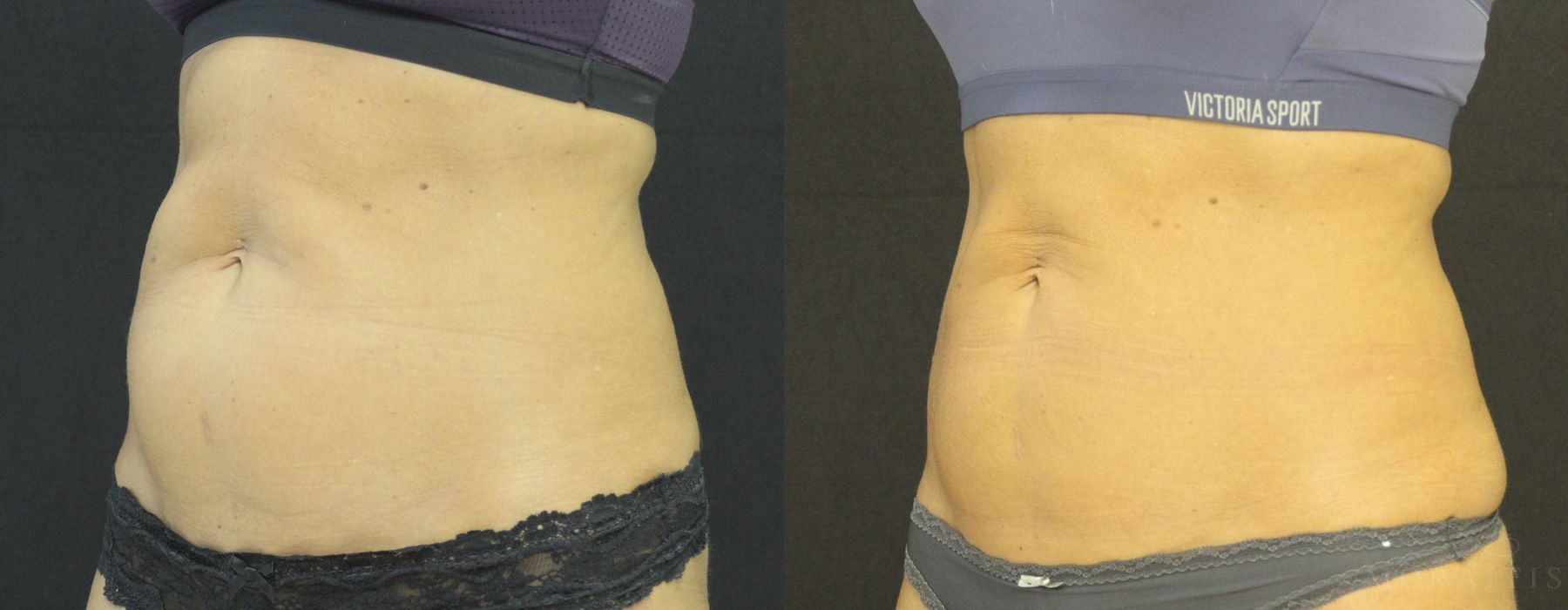 Coolsculpting (non-Surgical Body Contouring) - Case 15315