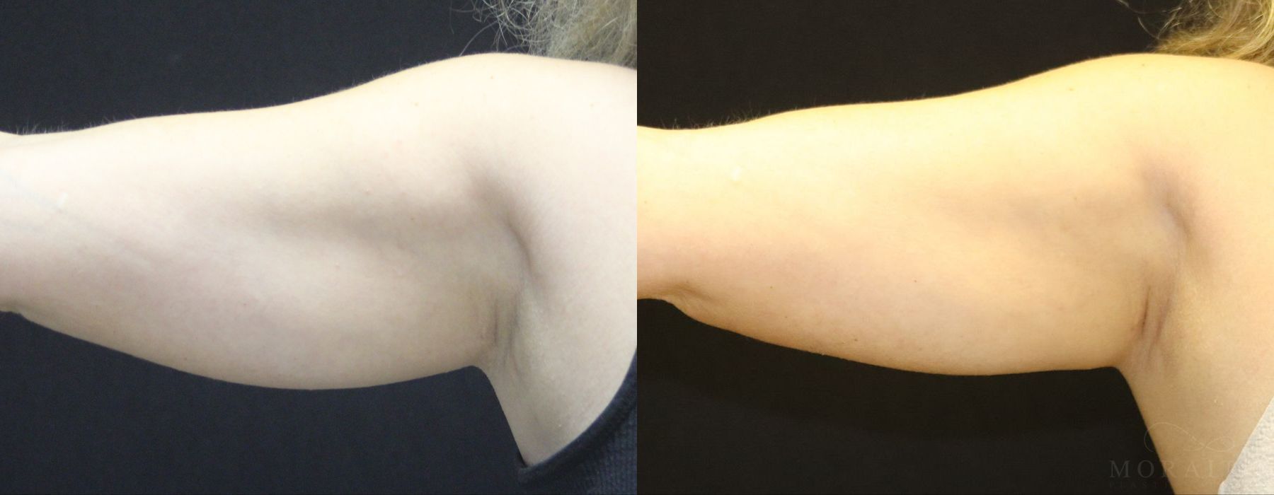 Coolsculpting (Non-Surgical Body Contouring) - Thumbnail 2