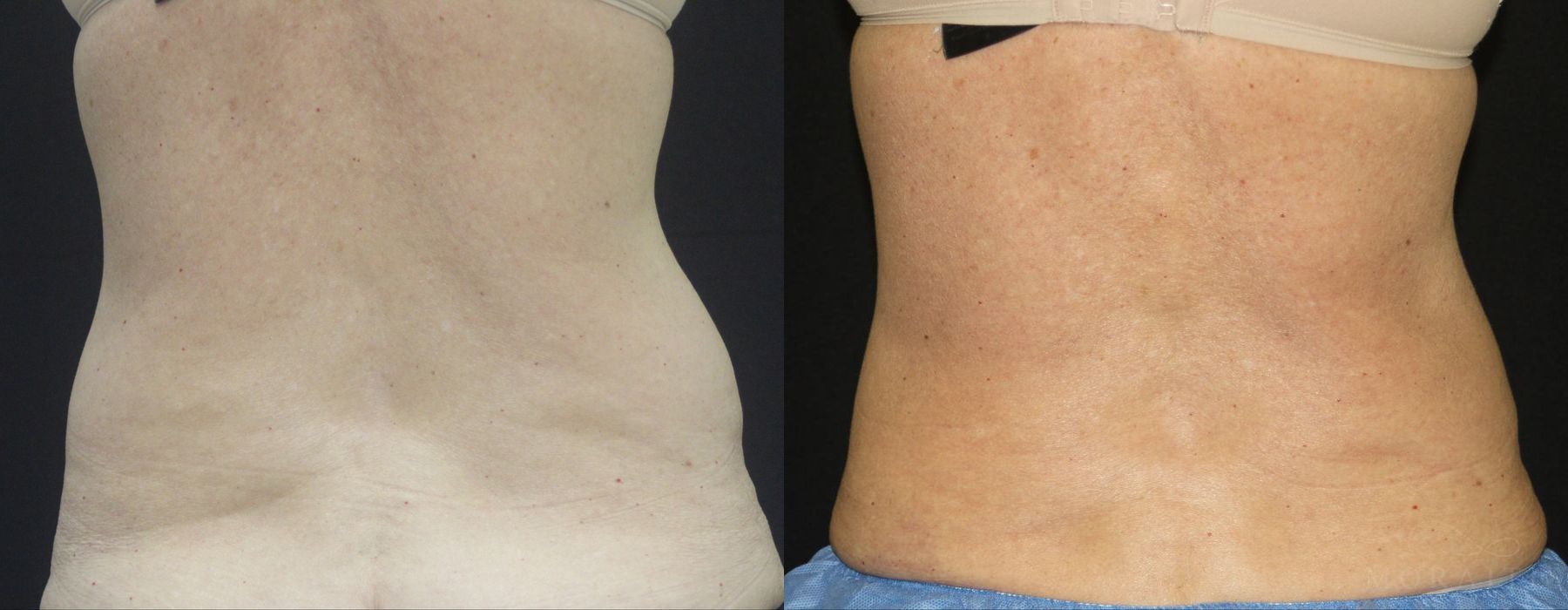 Coolsculpting (non-Surgical Body Contouring) - Case 15329