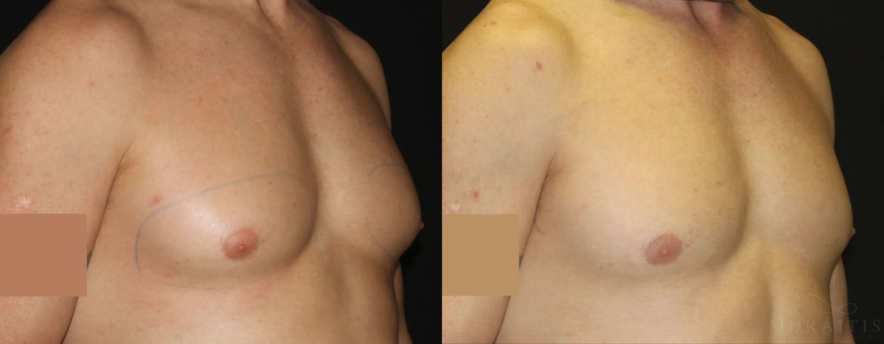 Coolsculpting (non-Surgical Body Contouring) - Thumbnail 2