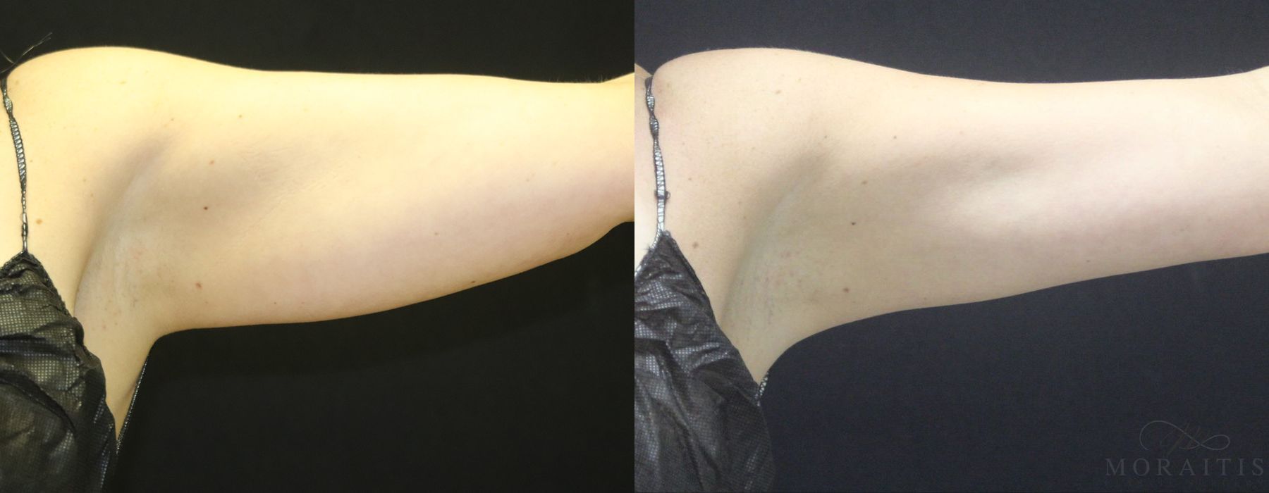 Coolsculpting (Non-Surgical Body Contouring) - Case 19956