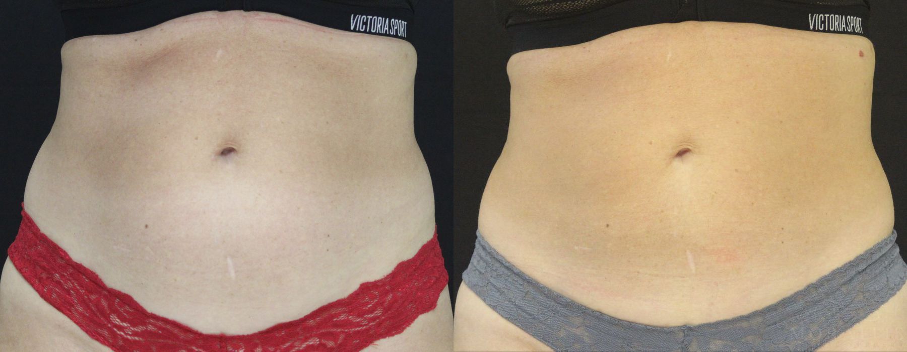Coolsculpting (non-Surgical Body Contouring) - Case 15316