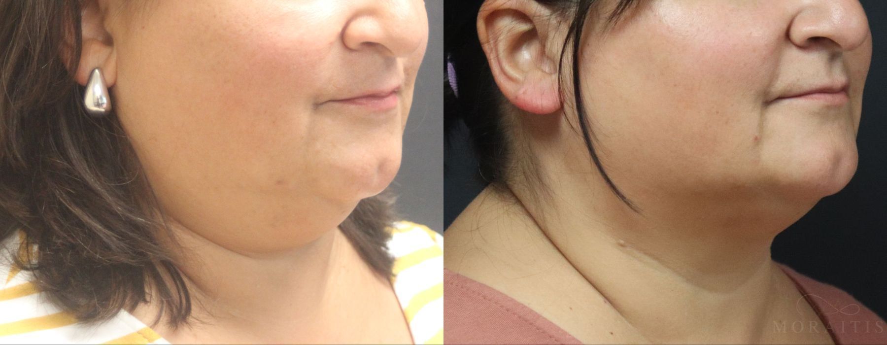 Coolsculpting (non-Surgical Body Contouring) - Thumbnail 2