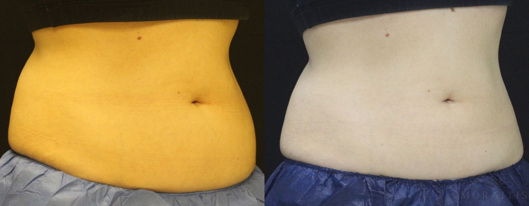 Coolsculpting (non-Surgical Body Contouring) - Thumbnail 2