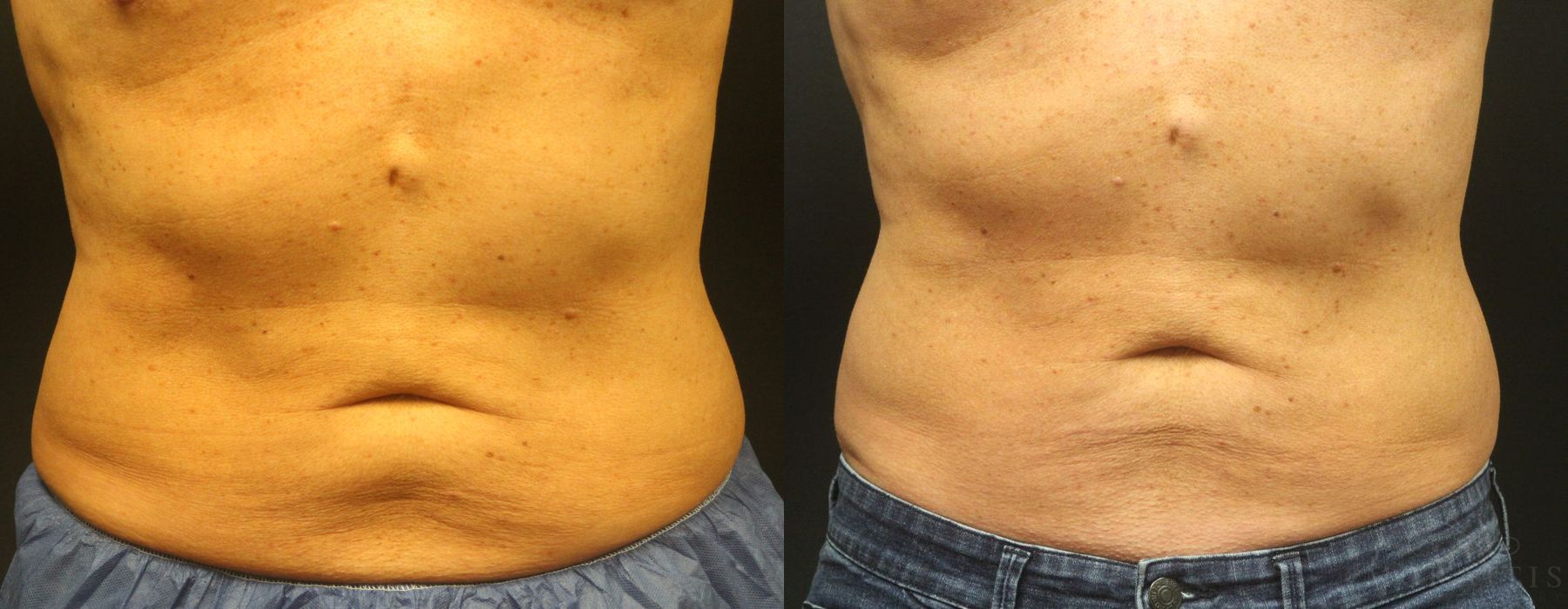 Coolsculpting (non-Surgical Body Contouring) - Case 15328