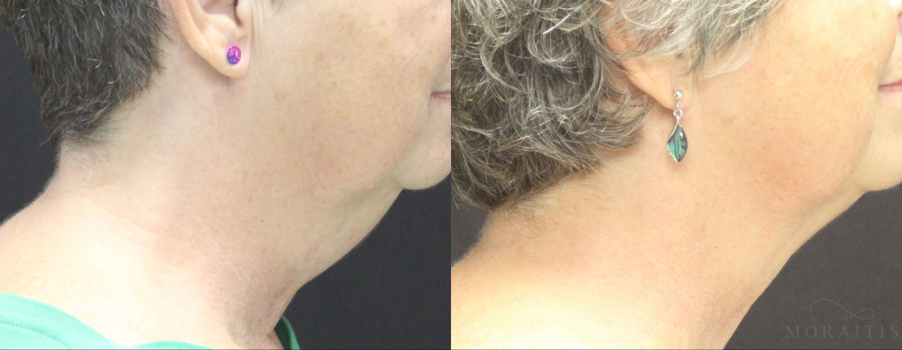 Coolsculpting (Non-Surgical Body Contouring) - Case 19944