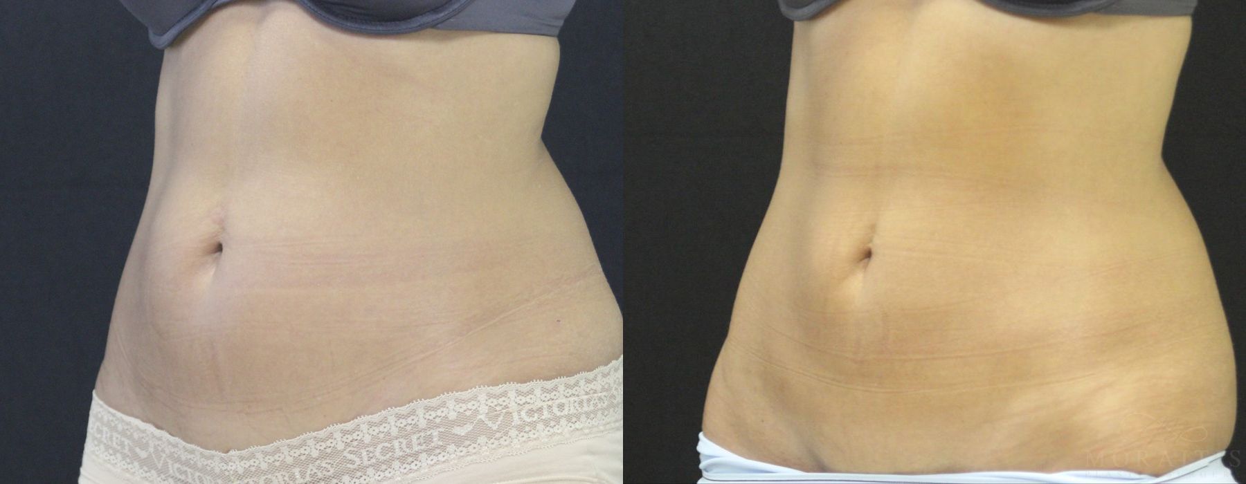 Coolsculpting (non-Surgical Body Contouring) - Thumbnail 2