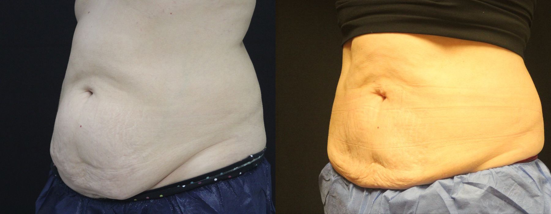 Coolsculpting (non-Surgical Body Contouring) - Thumbnail 2