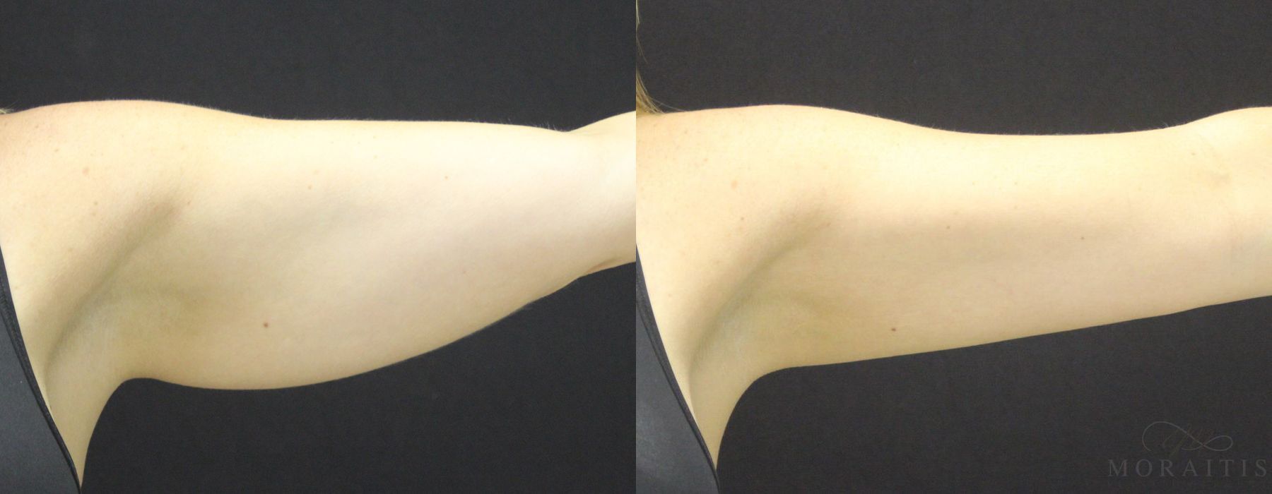 Coolsculpting (non-Surgical Body Contouring) - Case 15310