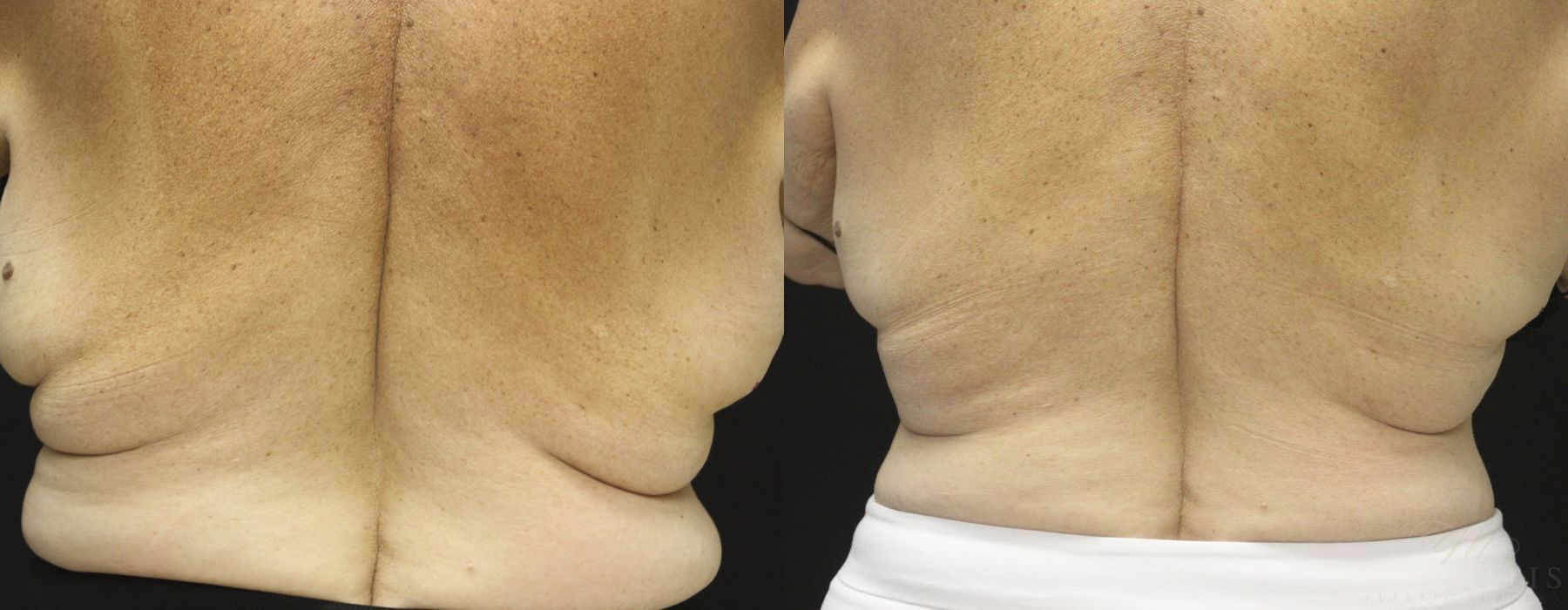 Coolsculpting (non-Surgical Body Contouring) - Case 15319