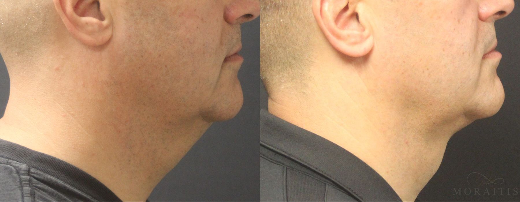 Coolsculpting (non-Surgical Body Contouring) - Case 15327