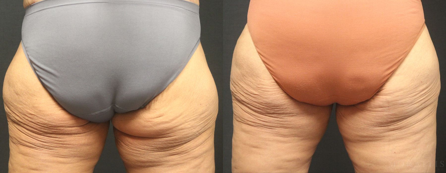 Coolsculpting (non-Surgical Body Contouring) - Case 15323