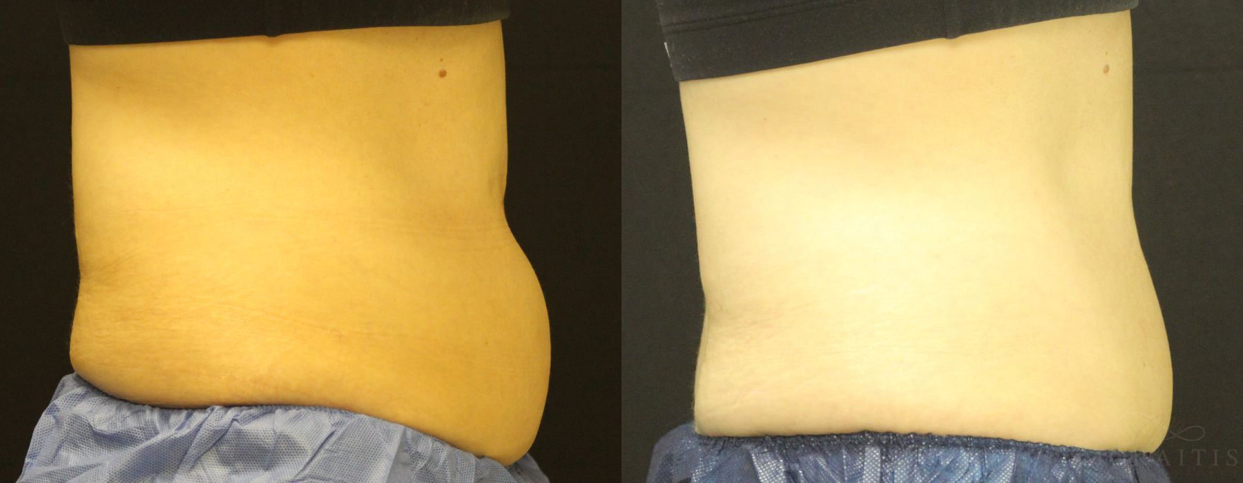Coolsculpting (non-Surgical Body Contouring) - Case 15325