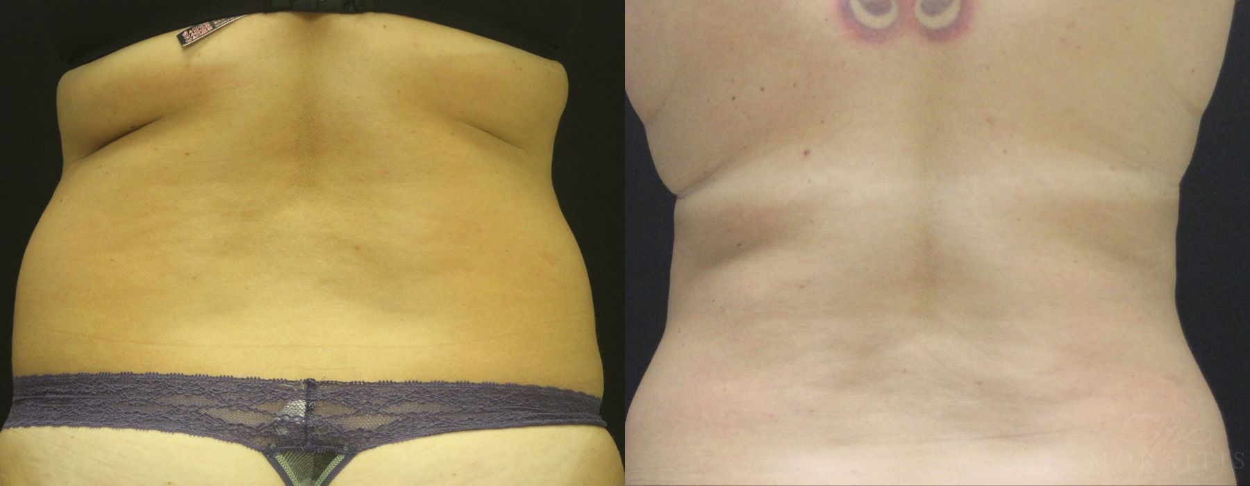Coolsculpting (Non-Surgical Body Contouring) - Case 19957