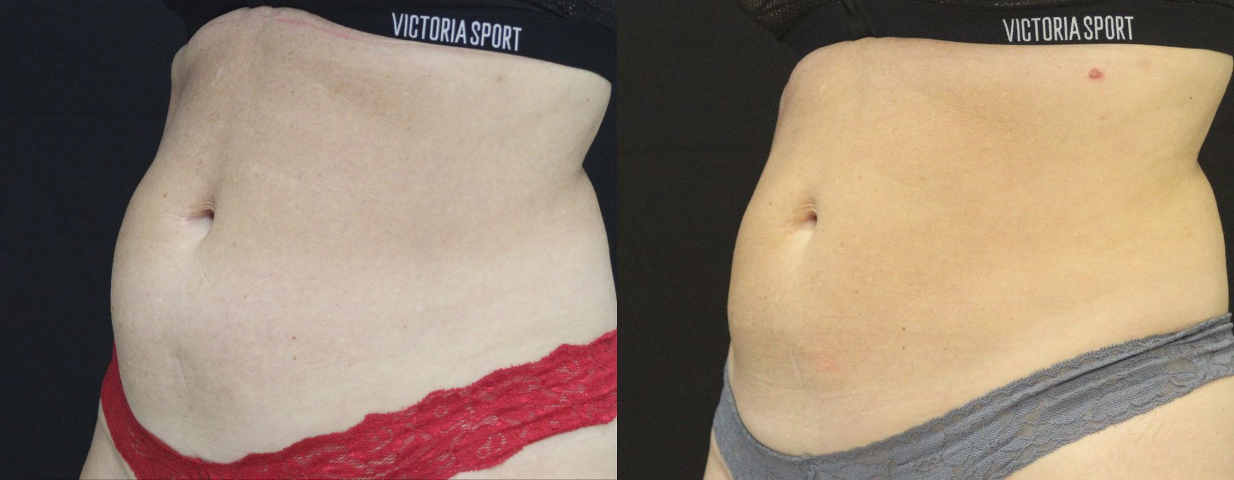 Coolsculpting (non-Surgical Body Contouring) - Thumbnail 2